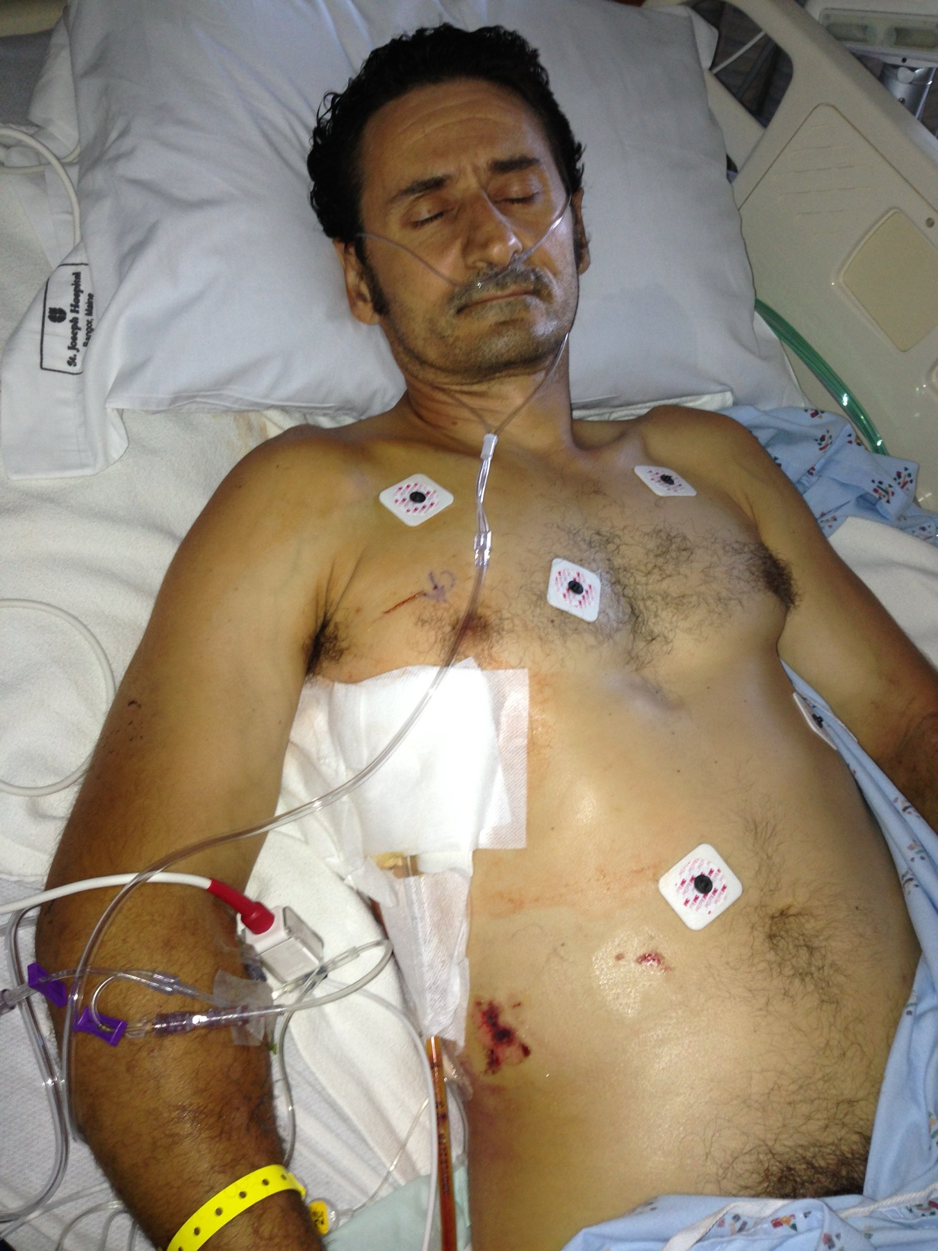 Andrea Campanella in a hospital bed in 2013, with chest tubes and monitors attached, days after his fall.